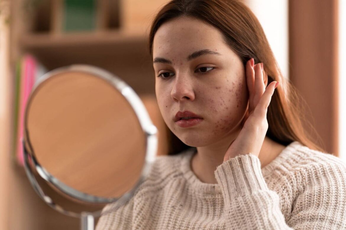acne scar treatment