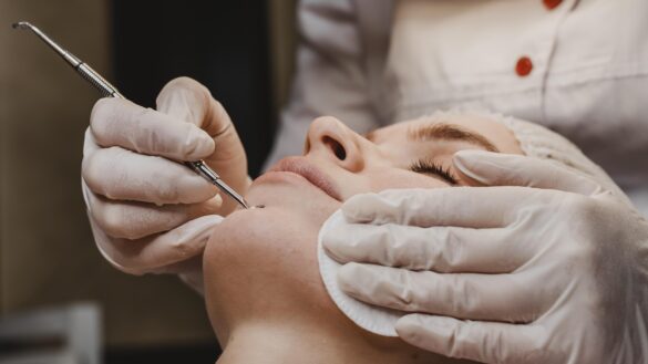 Remove Acne Scars